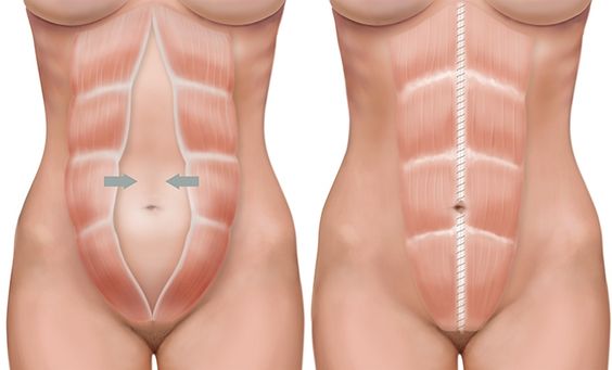 diastasis abdominal que es