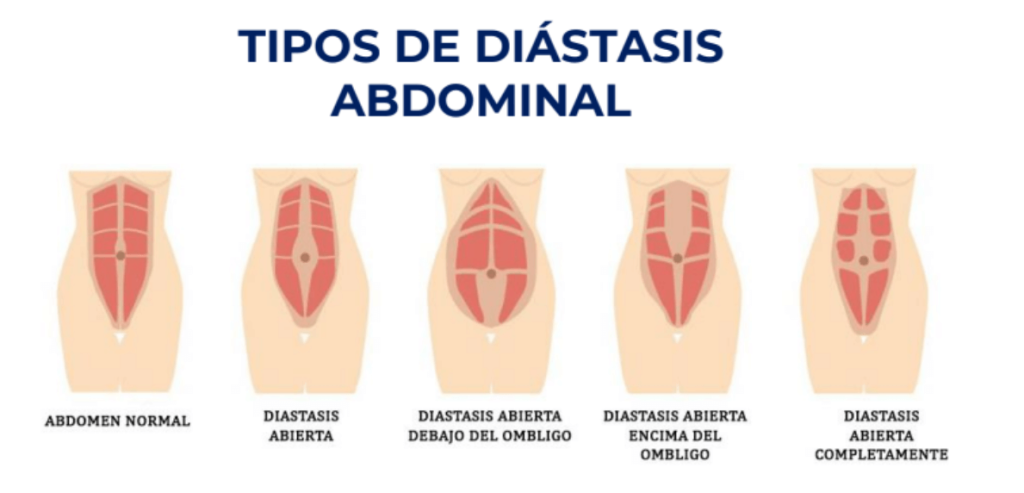 diástasis abdominal tipos