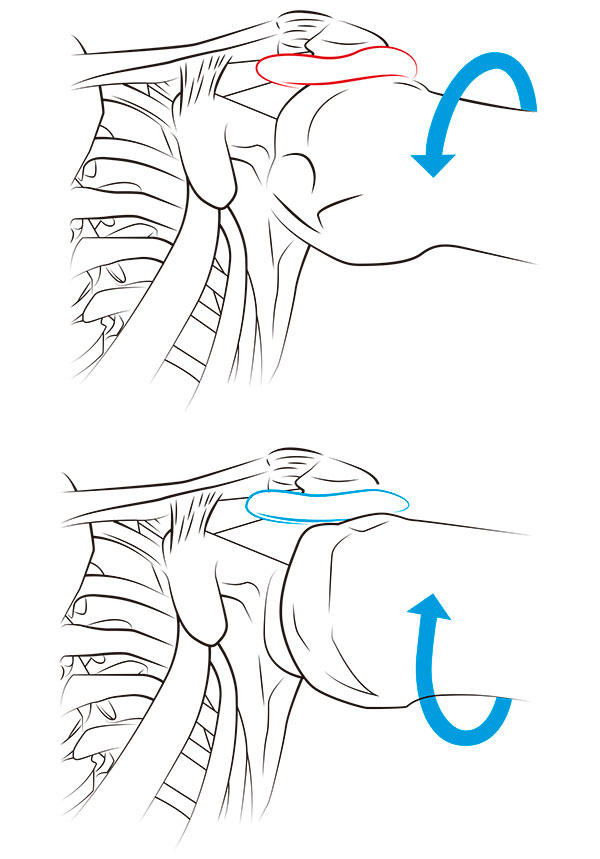 tendinitis-manguito-rotador-ejemplo