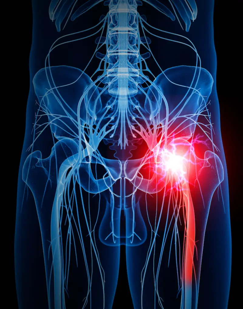 tendinitis isquiotibial y el nervio ciatico