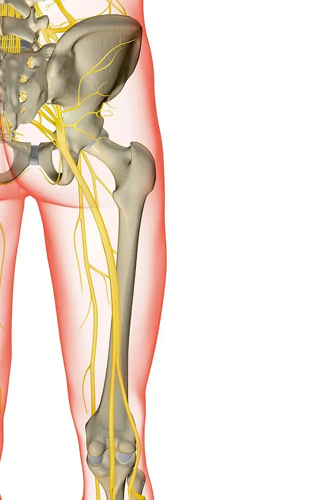 tendinitis isquiotibial y nervio ciatico